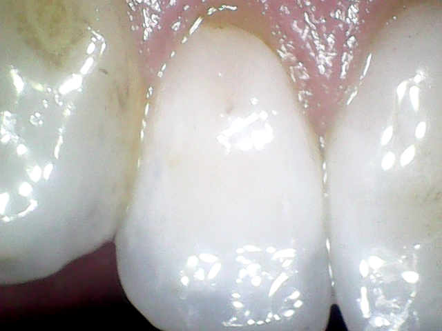 USB Personal Dental Intraoral Camera