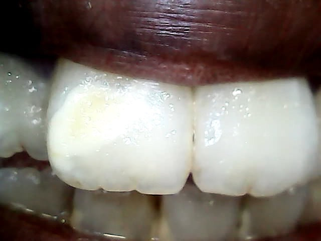 Intraoral Camera