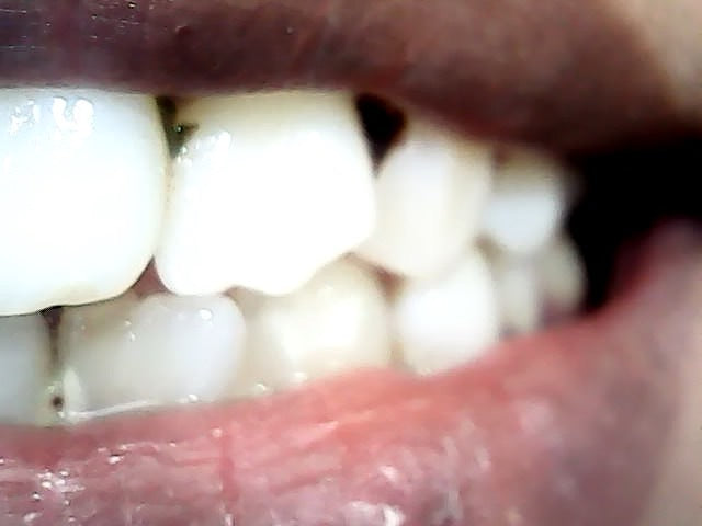 Intraoral Camera