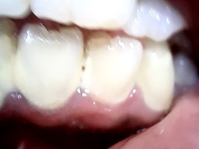 Intraoral Camera