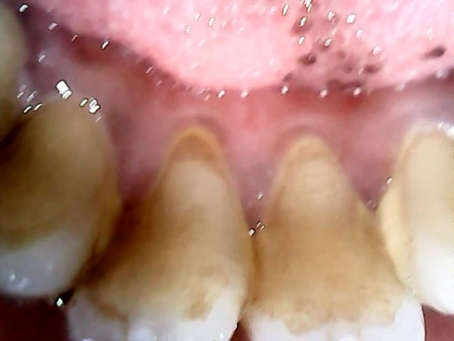 Intraoral Camera