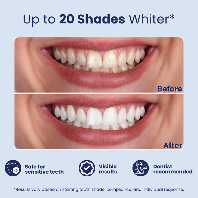 Before-and-after comparison of teeth whitening results, showing a close-up of a smiling mouth with yellowed teeth labeled 'Before' and whiter teeth labeled 'After' on a light blue background with feature icons.